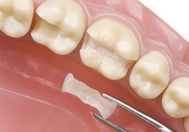 hampaita ja keraaminen täyteaine